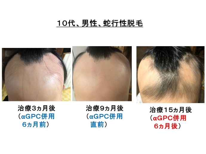 蛇行性脱毛の男子患者様、αGPC併用で、明らかな改善が！ |患者様 