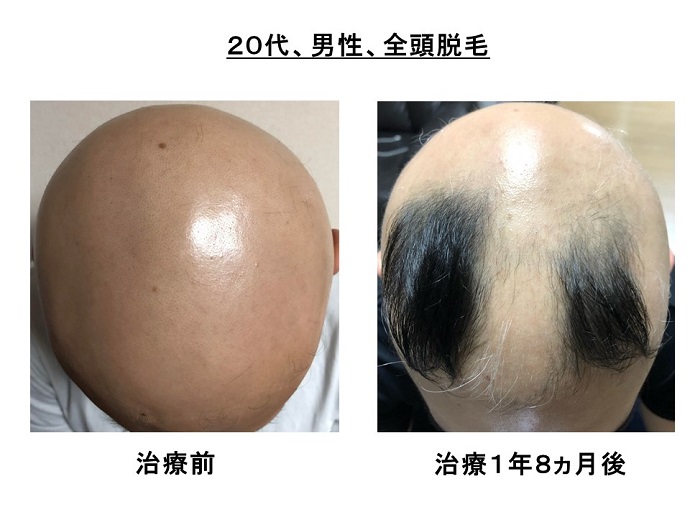 円形脱毛症 名医 円形脱毛症 病院