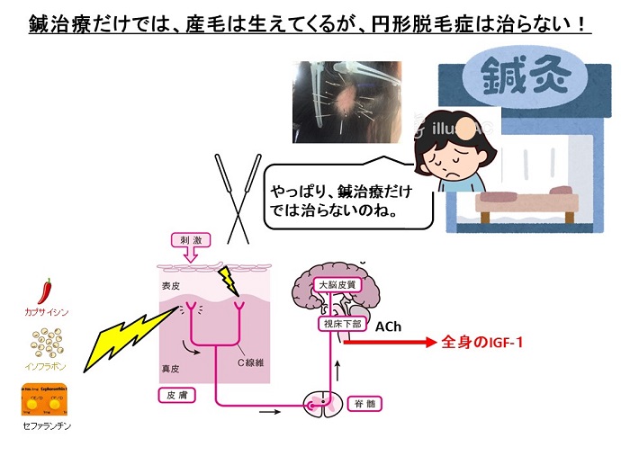 円形脱毛症　病院