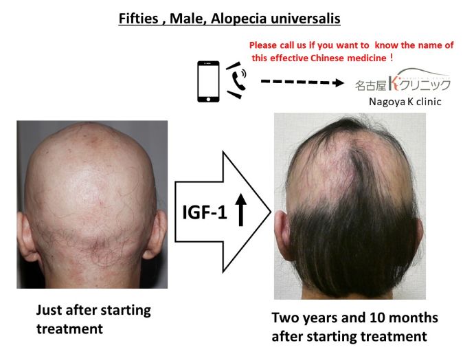 円形脱毛症　病院