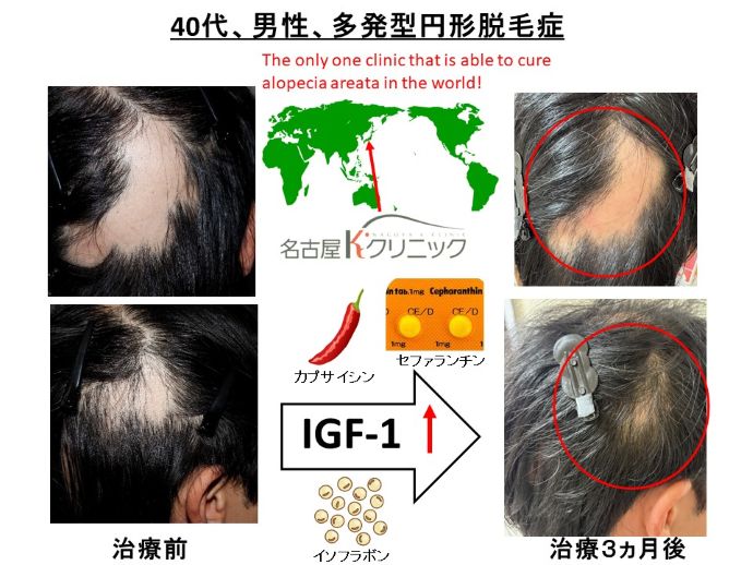 alopecia areata 円形脱毛症 病院