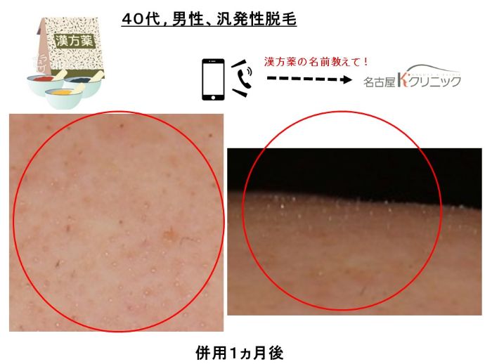 円形脱毛症　病院