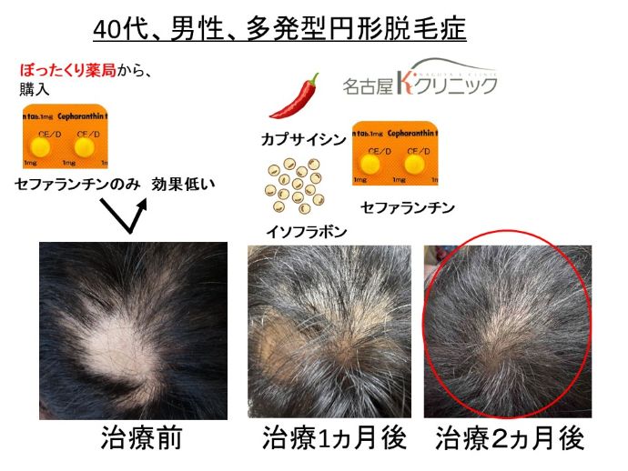 円形脱毛症 名医 円形脱毛症 病院