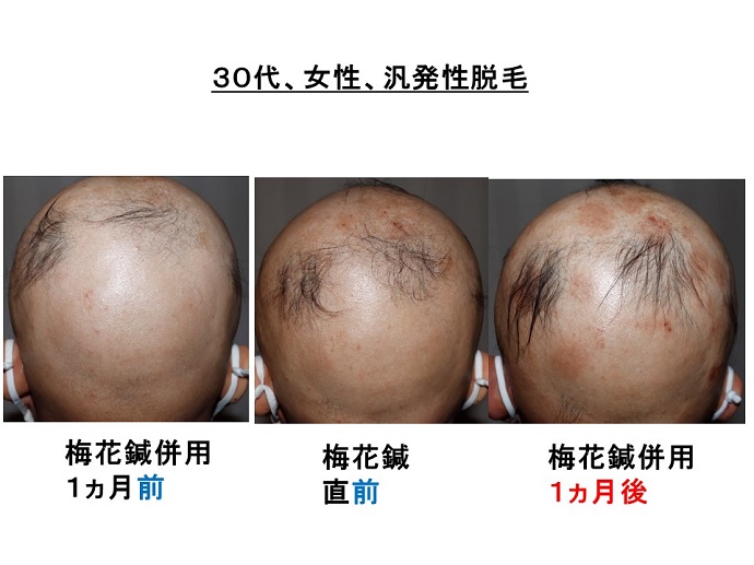 1回の梅花鍼の併用で、頭皮の痒みが強くなり、毛が太くなりました 