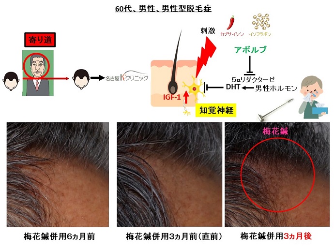 9年間の治療の後でも、梅花鍼で新たな産毛が！そして、鼻水も！なぜ 