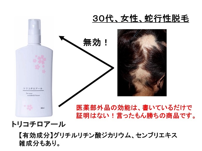 育毛剤トリコチロアール、脱毛症に効きませんでした！ |患者様からの声 